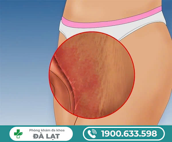 PHÒNG KHÁM ĐA KHOA ĐÀ LẠT - GIẢI PHÁP HIỆU QUẢ CHO TÌNH TRẠNG MỤN SƯNG ĐAU VÙNG KÍN
