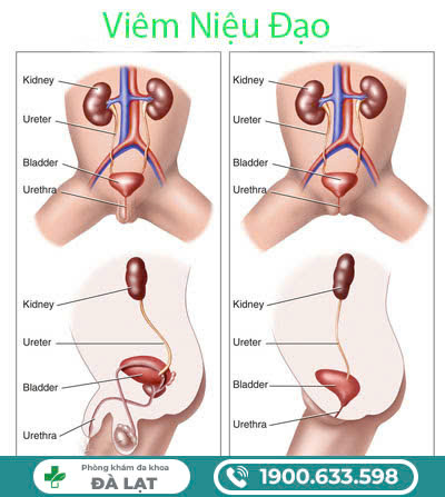 Viêm niệu đạo có lây không? Qua đường nào?