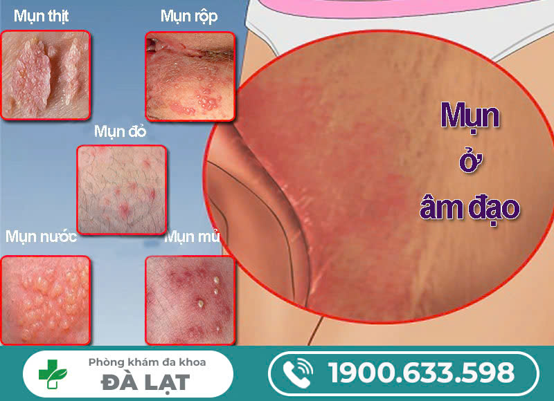 Vùng kín mọc mụn và ngứa là do bệnh gì – Phương pháp khắc phục hiệu quả cho chị em