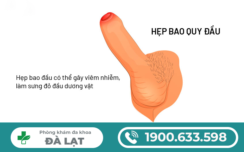 BAO QUY ĐẦU DÀI VÀ HẸP ? PHƯƠNG PHÁP ĐIỀU TRỊ HIỆU QUẢ NHẤT 2025? 