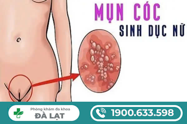 Những điều bất ngờ về mụn cóc sinh dục nữ