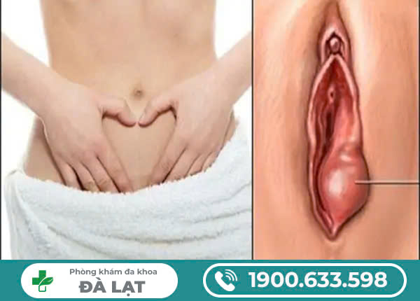 THỊT THỪA Ở VÙNG KÍN NỮ