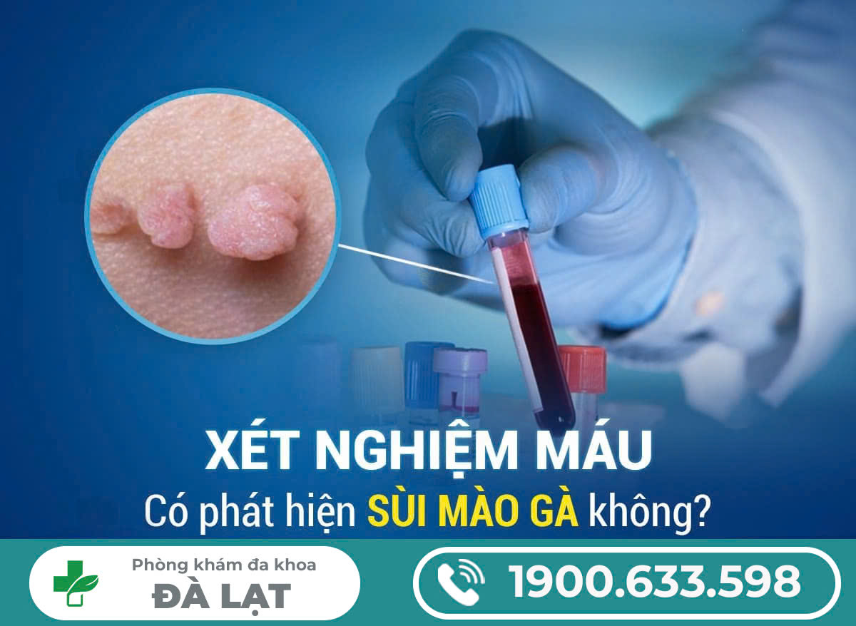XÉT NGHIỆM MÁU PHÁT HIỆN BỆNH SÙI MÀO GÀ TẠI PHÒNG KHÁM ĐA KHOA ĐÀ LẠT