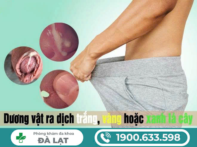 Dương vật chảy dịch trắng - Nguyên nhân và cách chữa