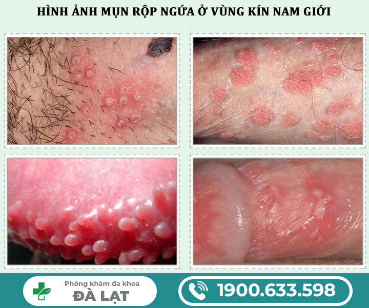 Nổi mụn ở dương vật: những điều quan trọng bạn cần biết