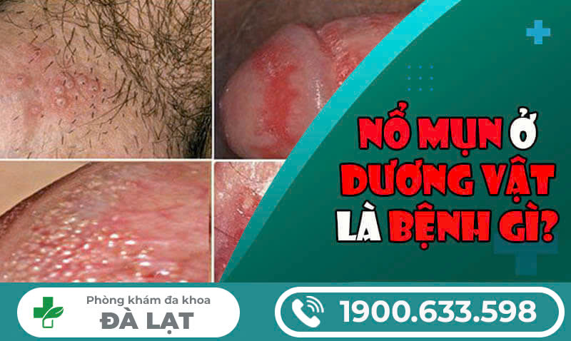 NGUYÊN NHÂN CẬU NHỎ MỌC MỤN VÀ CÁCH XỬ LÝ HIỆU QUẢ TẠI PHÒNG KHÁM ĐA KHOA ĐÀ LẠT