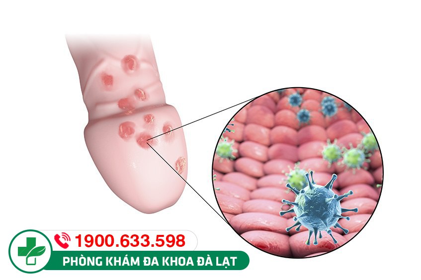 Nổi mụn ở bao quy đầu có sao không? Điều trị thế nào?