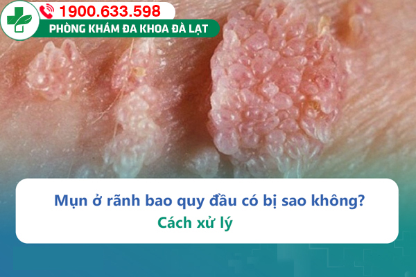 Mụn ở rãnh bao quy đầu có bị sao không? Cách xử lý