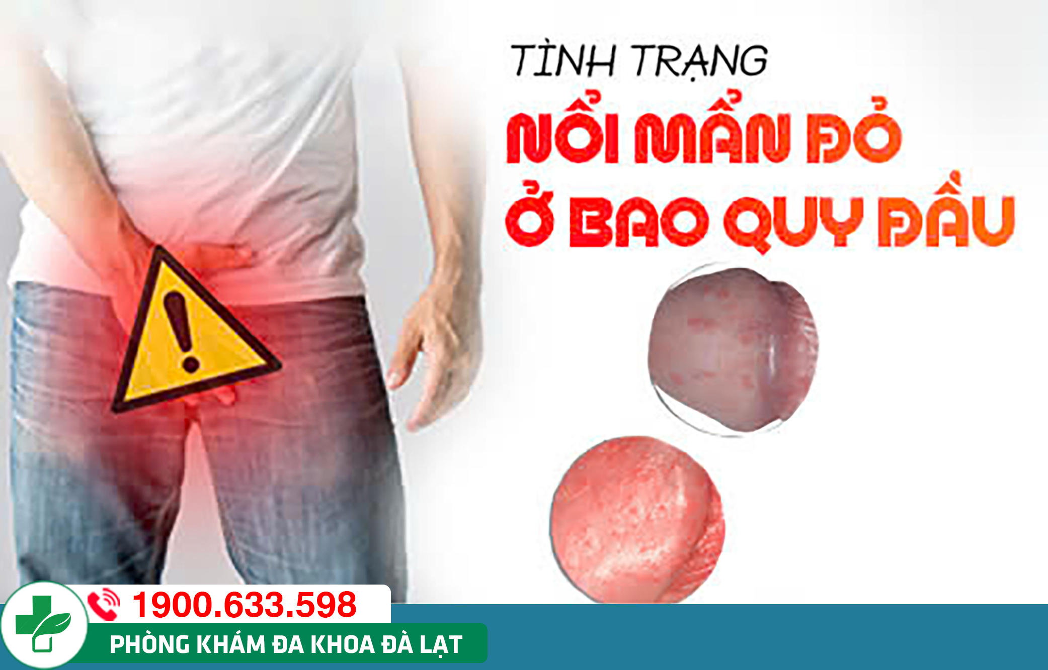 Nổi nốt đỏ ở bao quy đầu – Bác sĩ nói gì?