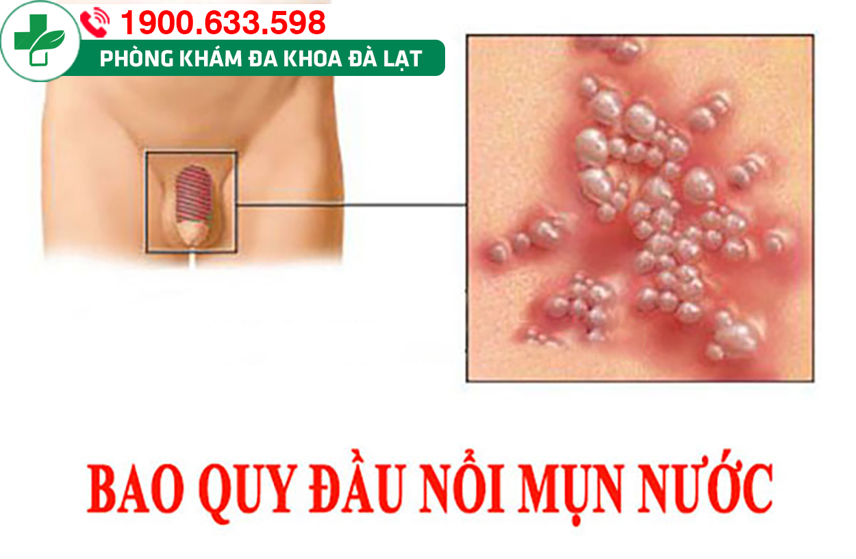 MỤN NƯỚC BAO QUY ĐẦU VÀ PHƯƠNG PHÁP ĐIỀU TRỊ