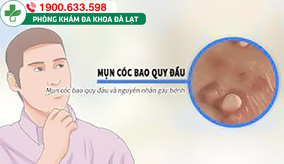 Mụn cóc ở bao quy đầu: Nguyên nhân và phương pháp điều trị