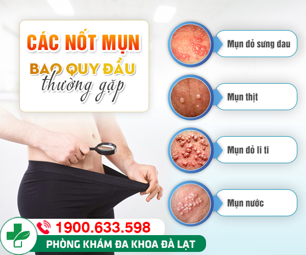 Mụn thịt ở bao quy đầu là bệnh gì? Phương pháp điều trị hiệu quả