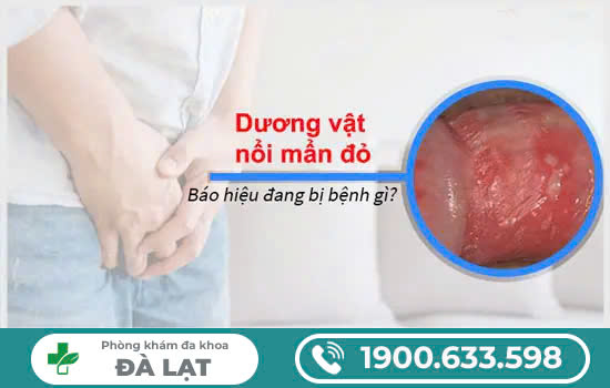 DƯƠNG VẬT NỔI MẨN – NGUYÊN NHÂN VÀ CÁCH ĐIỀU TRỊ TẠI PHÒNG KHÁM ĐA KHOA ĐÀ LẠT