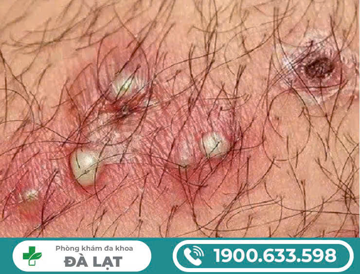 ÂM ĐẠO NỔI MỤN BỌC? PHƯƠNG PHÁP ĐIỀU TRỊ HIỆU QUẢ NHẤT? 