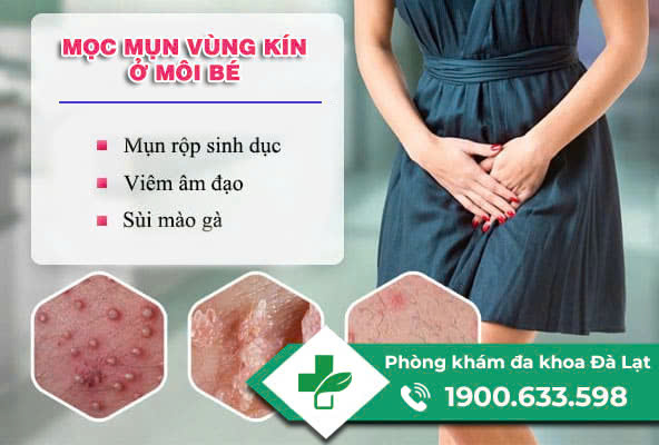 NỔI MỤN NƯỚC Ở MÔI BÉ