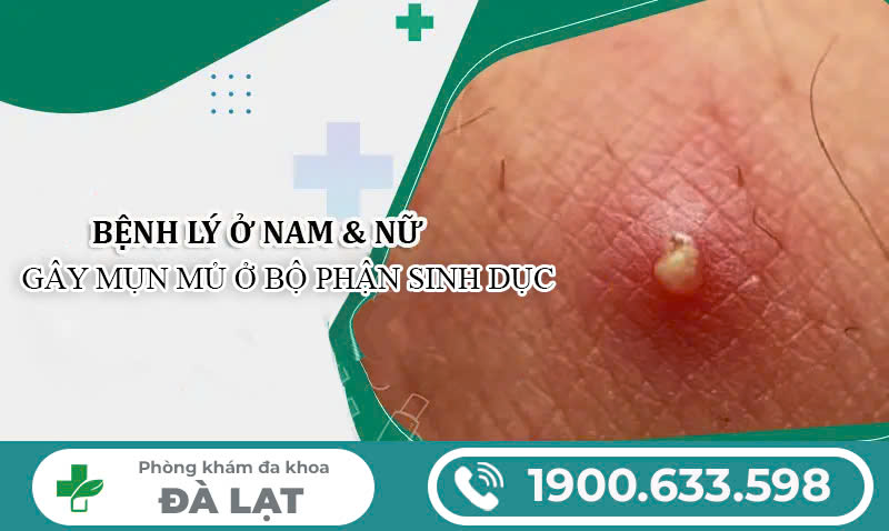 BỊ MỤN MỦ Ở BỘ PHẬN SINH DỤC – ĐỪNG CHỦ QUAN