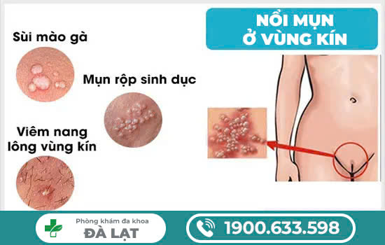 Mụn thịt ở vùng kín báo hiệu bệnh gì? Dấu hiệu để nhận biết