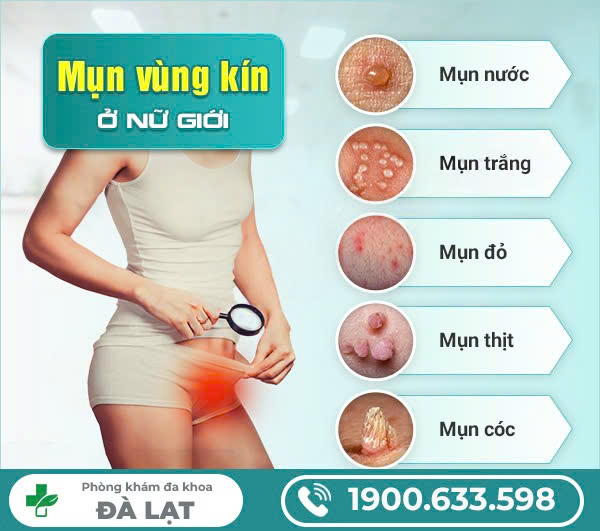 Mọc mụn đầu trắng ở vùng kín – nguyên nhân và cách điều trị
