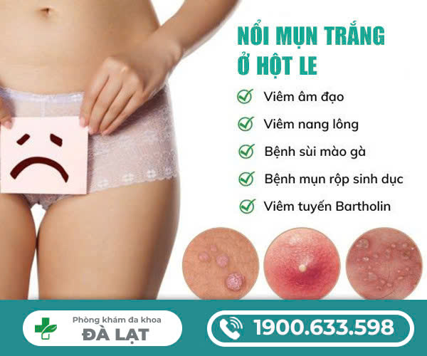 NỔI MỤN TRẮNG Ở HỘT LE
