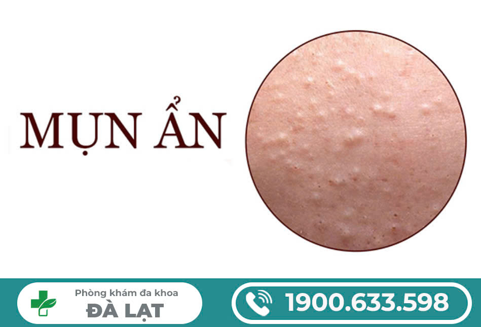 MỌC MỤN ẨN Ở VÙNG KÍN NAM VÀ NỮ