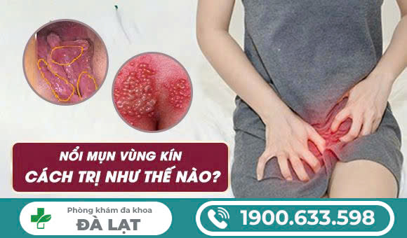 MỌC MỤN CÓ NHÂN Ở VÙNG KÍN