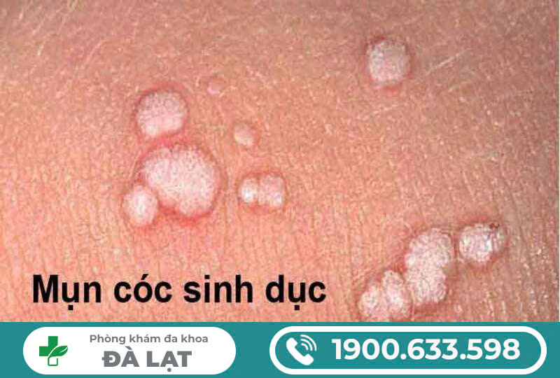 MỌC MỤN CƠM SINH DỤC