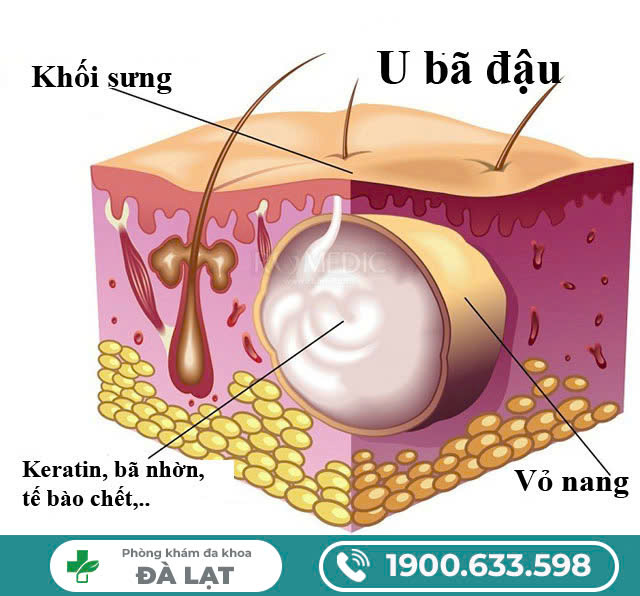 MỤN BÃ ĐẬU Ở VÙNG KÍN