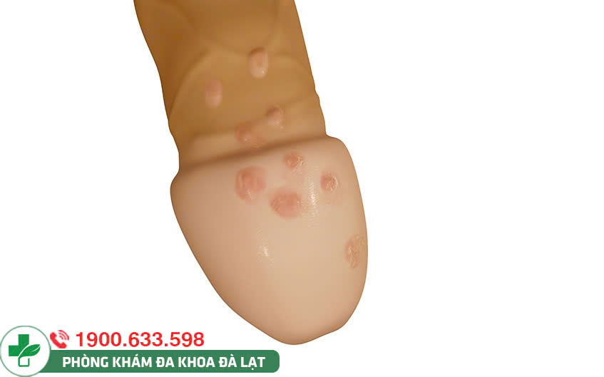 DƯƠNG VẬT NỔI MỤN CƠM
