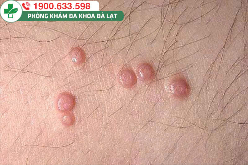 MỌC MỤN VÙNG KÍN NHƯNG KHÔNG ĐAU