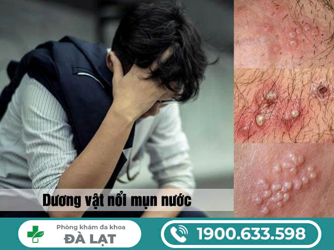 MỌC MỤN NƯỚC VÙNG KÍN