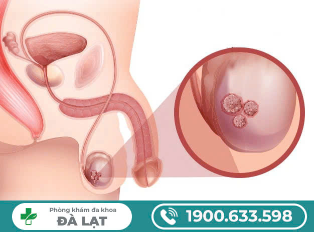 Nang mào tinh hoàn - bệnh lý nam giới không nên lơ là!