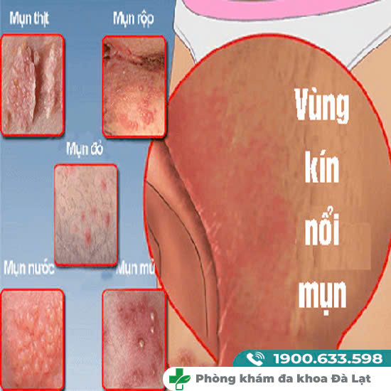 ÂM ĐẠO MỌC MỤN BỌC, MỤN NƯỚC, MỤN TRẮNG, MỤN LITI