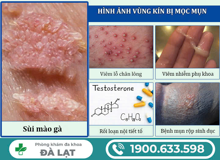 MỌC MỤN Ở VÙNG KÍN NAM GIỚI