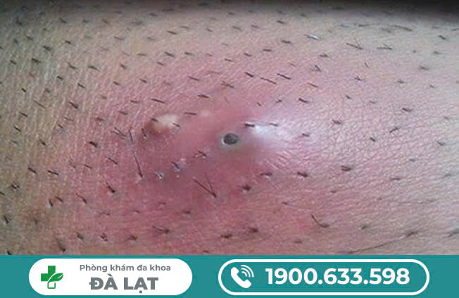 NỔI MỤN CỨNG Ở MÉP VÙNG KÍN NỮ GIỚI