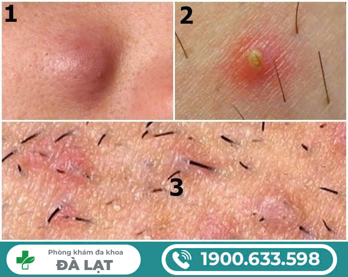CÁC LOẠI MỤN VÙNG KÍN