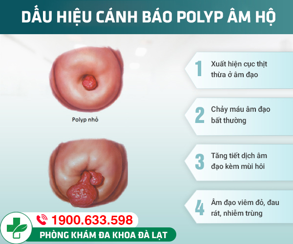 TÌM HIỂU VỀ BỆNH POLYP ÂM HỘ