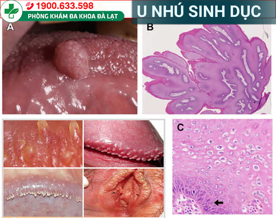 NGUYÊN NHÂN GÂY U NHÚ SINH DỤC NAM