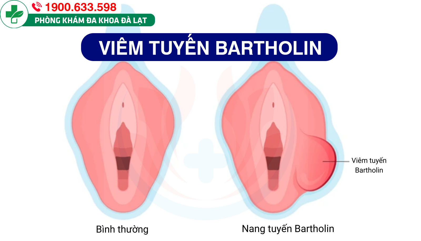 Nang tuyến Bartholin (viêm tuyến Bartholin): phương pháp điều trị hiệu quả