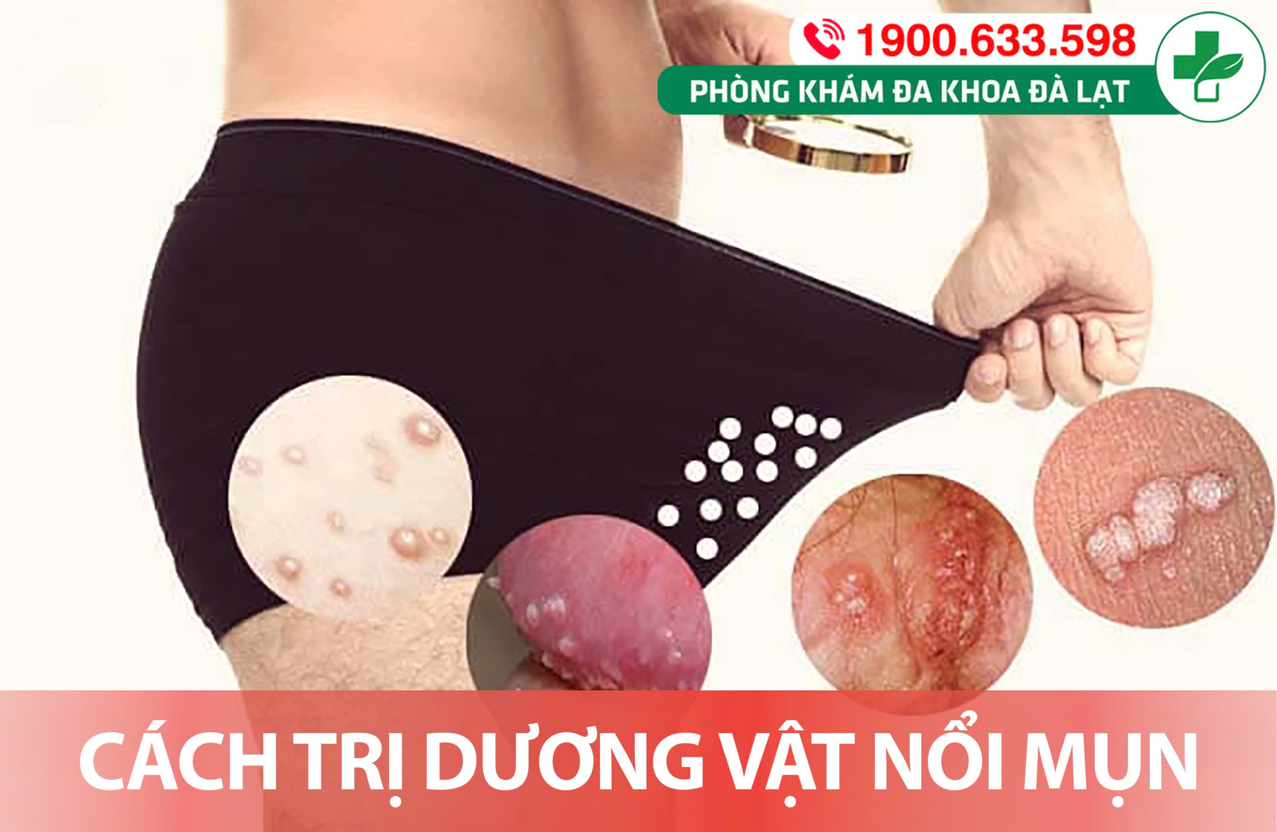 MỤN CƠM DƯƠNG VẬT: TRIỆU CHỨNG VÀ CÁCH ĐIỀU TRỊ TỪ CHUYÊN GIA
