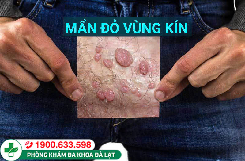 Vùng kín bị nổi mẩn đỏ: Nguyên nhân, biểu hiện và cách điều trị