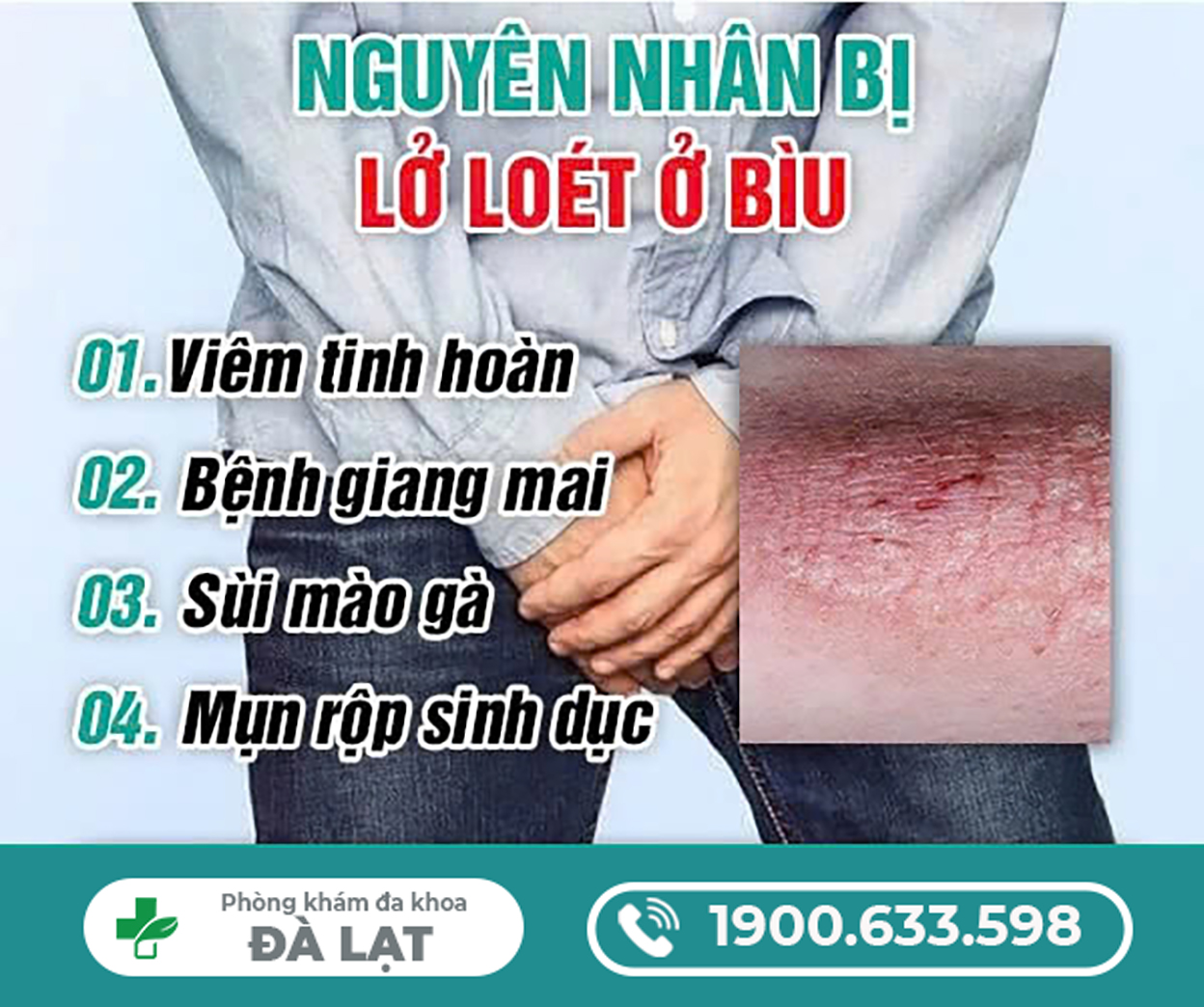 THẬN TRỌNG KHI BỊ LỞ LOÉT Ở BÌU