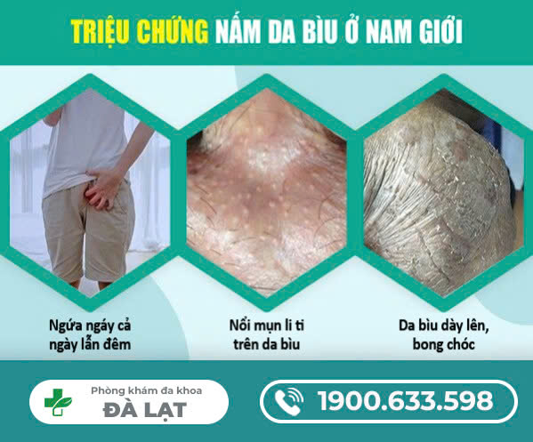 BỆNH NẤM BÌU: NHỮNG THÔNG TIN CẦN BIẾT