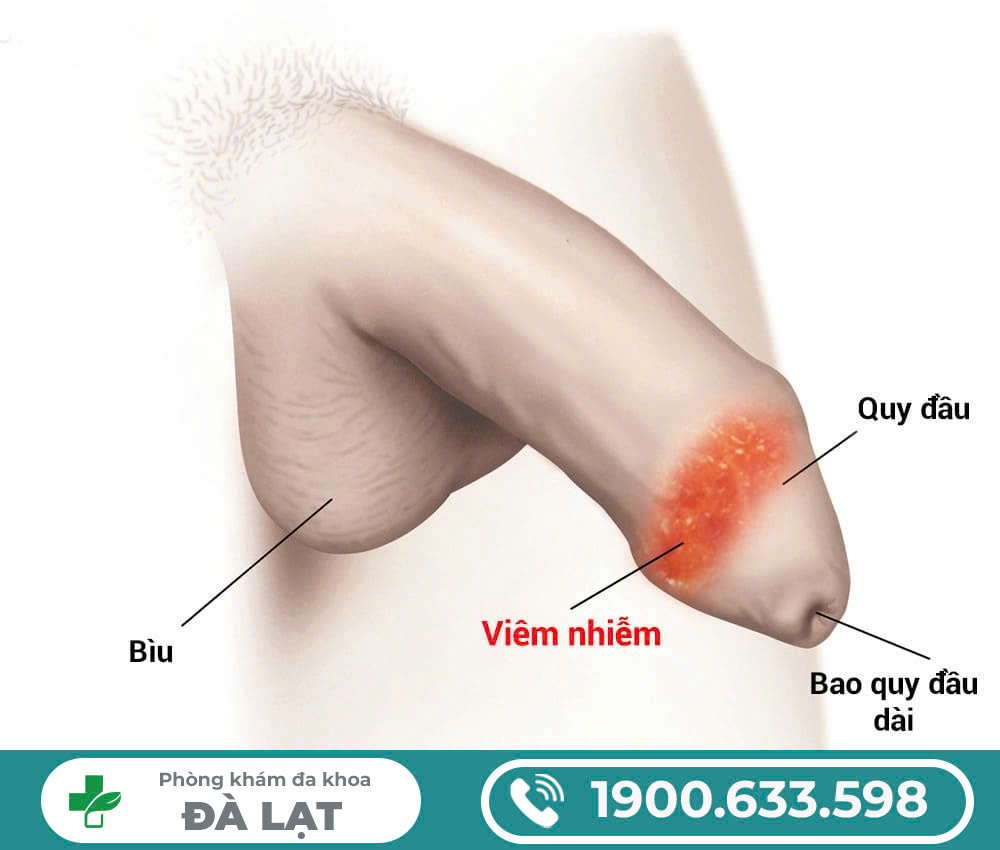 PHƯƠNG PHÁP CẮT BAO QUY ĐẦU CÔNG NGHỆ ITC