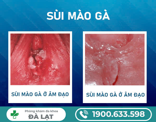 Bệnh sùi mào gà có nguy hiểm với nữ giới không? Phương pháp điều trị bệnh 