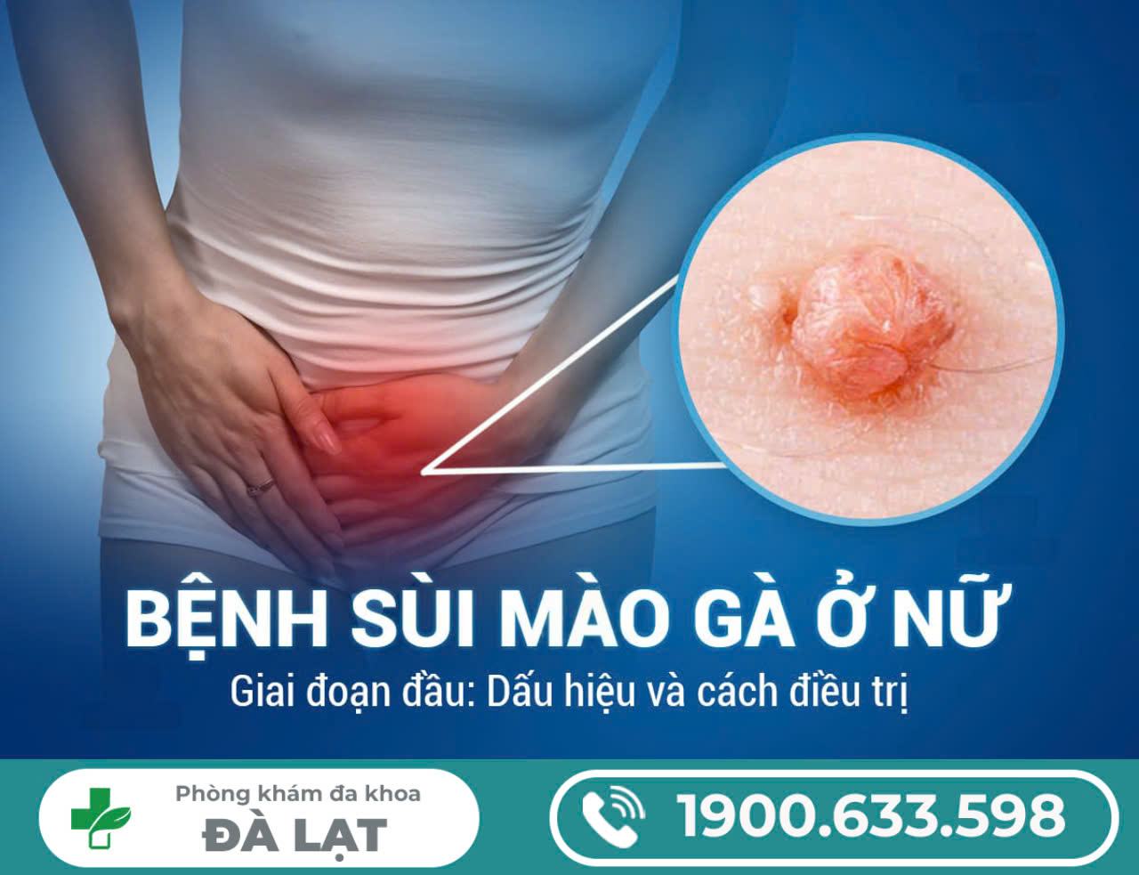 Sùi mào gà giai đoạn đầu của nữ giới: Dấu hiệu và phương pháp điều trị