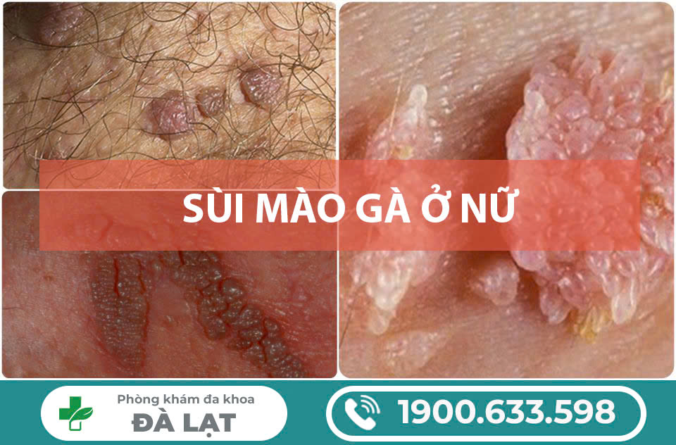Sùi mào gà có lây không? Cách điều trị như thế nào