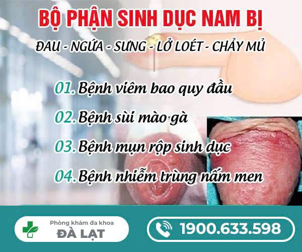 BỘ PHẬN SINH DỤC NAM BỊ ĐAU, NGỨA, SƯNG, LỞ LOÉT, CHẢY MỦ, NÓNG RÁT