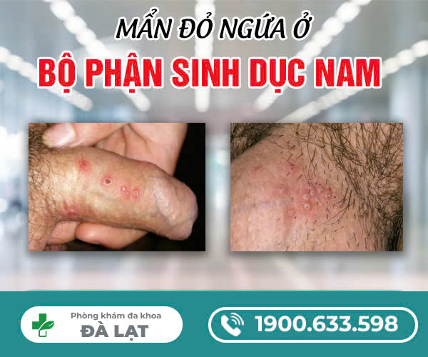 MẨN ĐỎ NGỨA Ở BỘ PHẬN SINH DỤC NAM
