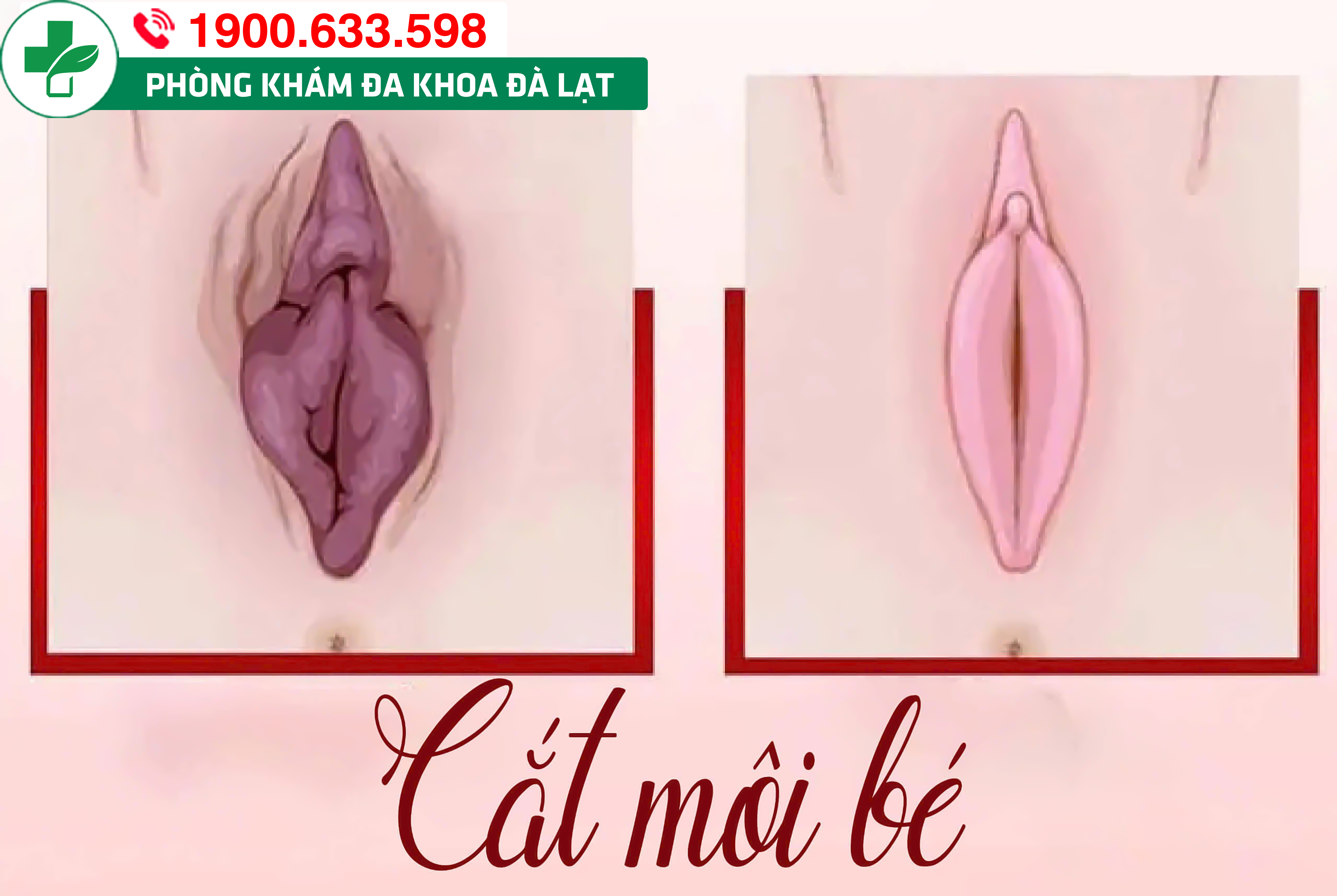 Thẩm mỹ cắt môi bé vùng kín: Quy trình thực hiện 
