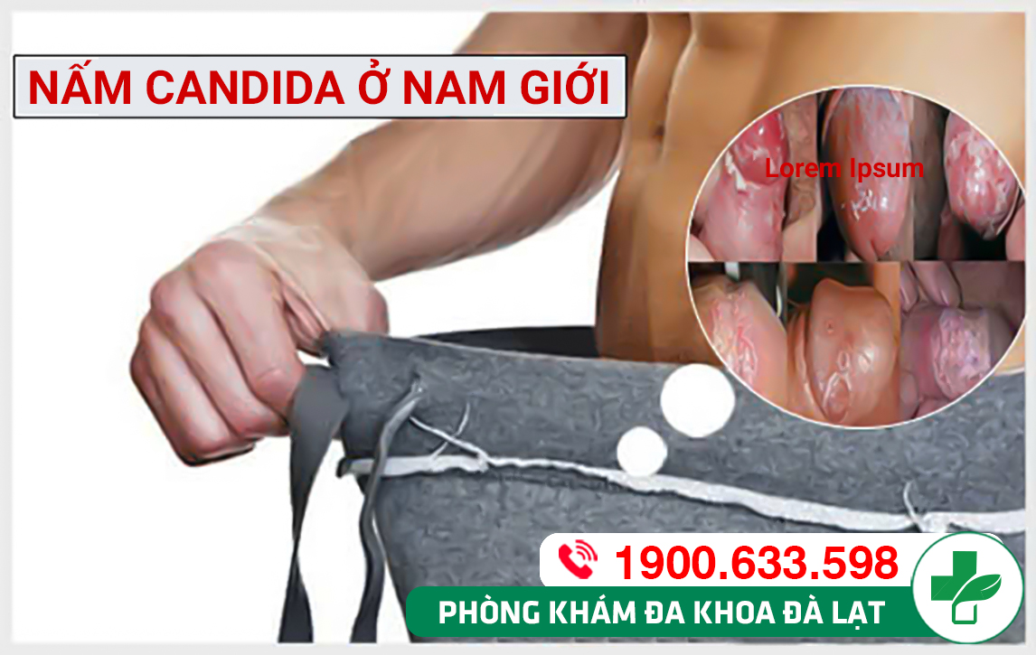 Dấu hiệu bệnh nấm candida ở nam giới